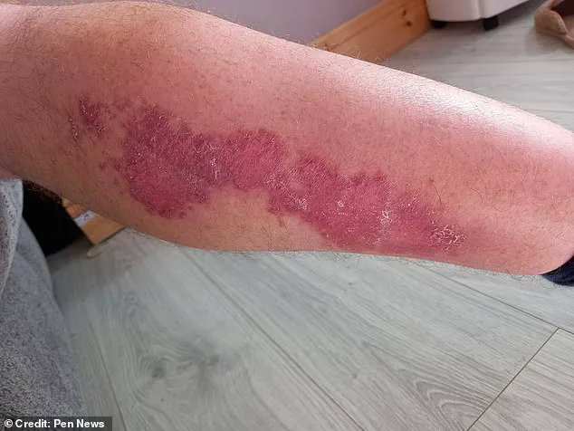 Noble False Widow Spider Bite Leaves Window Cleaner in Agony, Forced to Miss Work and Hospitalized