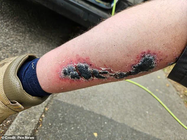 Noble False Widow Spider Bite Leaves Window Cleaner in Agony, Forced to Miss Work and Hospitalized