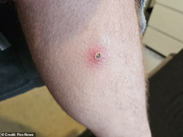 Noble False Widow Spider Bite Leaves Window Cleaner in Agony, Forced to Miss Work and Hospitalized