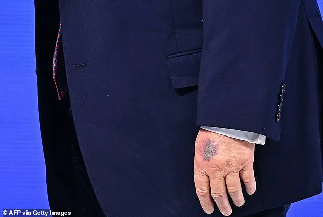 President Trump's Hand Bruise: A 'Little Accident' at Davos or Something More?
