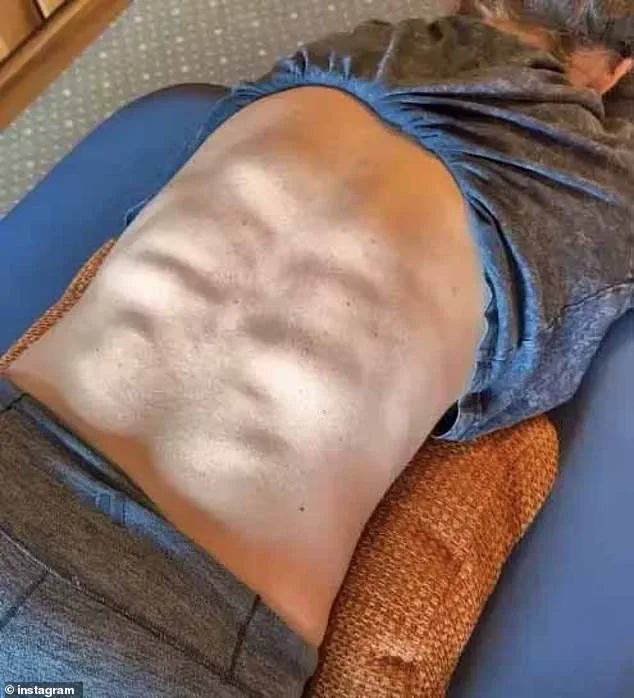 Mikaela Shiffrin Shares Sculpted Back Muscles and Discusses Spinal Health Challenges
