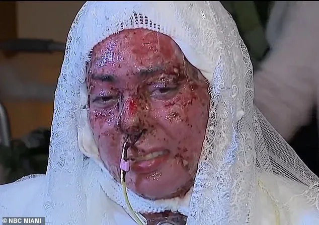 Love Defying Odds: Burned Woman Weds Fiancé in Hospital Chapel After Grill Explosion