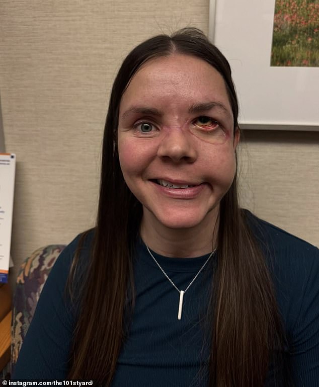 Kenai mother reveals severe injuries one year after bear attack